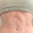 Fibrosis